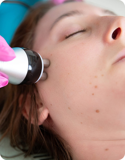 Non-surgical skin tightening treatment